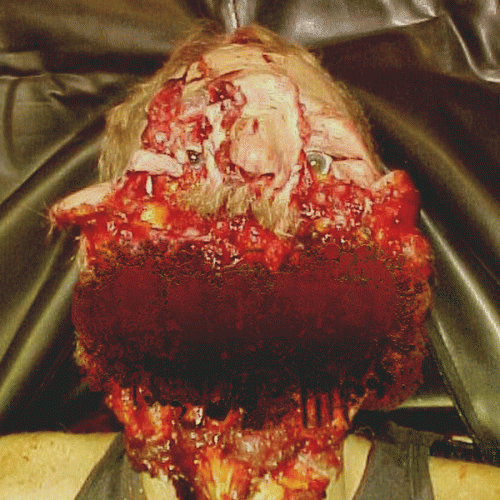 Blenncardichromodacryexgenitohaemgene : 4 Trax